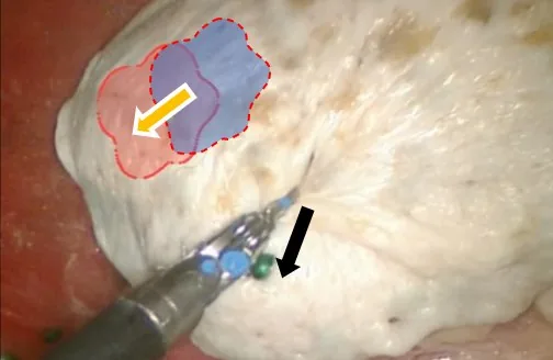 术中病灶随操作发生位移，术前规划的位置与实际位置分离